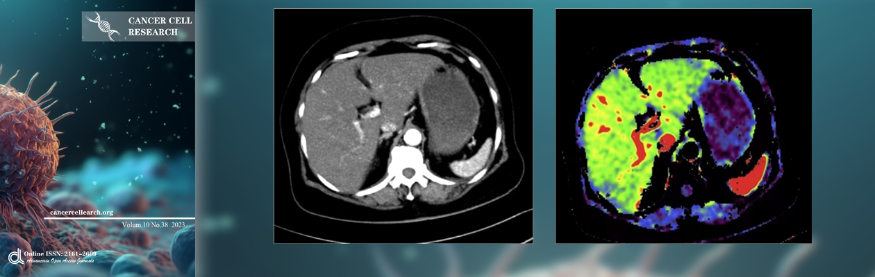 Plain and enhanced CT images of A patient with hepatocellular carcinoma